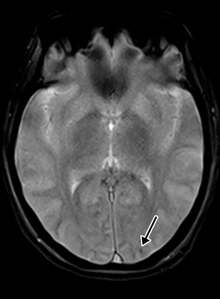 Hemorrhagic diffuse leukoencephalopathy in a 43-year-old woman with COVID-19. The hospital stay was complicated by inability to follow commands and persistently depressed status after extubation. The laboratory test results showed markedly elevated d-dimer levels (>7.6 mg/mL), international normalized ratio level (1.4), and platelet count (290). (a) Axial T2-weighted MR image shows confluent bilateral signal hyperintensities (arrows) in the white matter of both parietal lobes. No associated diffusion restriction was depicted on diffusion-weighted or ADC images (not shown). (b) Axial gradient-echo MR image shows punctate microhemorrhages (arrow) in the subcortical white matter of the left occipital lobe. Multiple microhemorrhages were scattered throughout the cerebral hemispheres bilaterally and in the splenium of the corpus callosum (not shown).