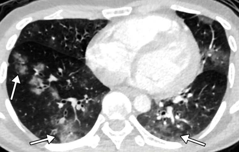 Rhabdomyolysis in a 34-year-old man who presented with minor trauma and was diagnosed with COVID-19 in the emergency department. Laboratory analysis results demonstrated an extremely high creatine kinase level of 35 145 U/L (normal range, 39–308 U/L). (a–c) Coronal (a) and axial (b, c) contrast-enhanced CT images of the pelvis show an enlarged right gluteal region (arrows) without associated fracture. (d–f) Axial (d) and coronal (e) contrast-enhanced chest CT images and a CT image with an artificial intelligence deep learning algorithm for the detection of pulmonary embolism (f) show bilateral multifocal multilobar peribronchovascular patchy airspace and ground-glass opacities (arrows in d), which are a typical finding for COVID-19. Multiple segmental and subsegmental right lower lobe pulmonary emboli (arrows in e and f) were also detected.