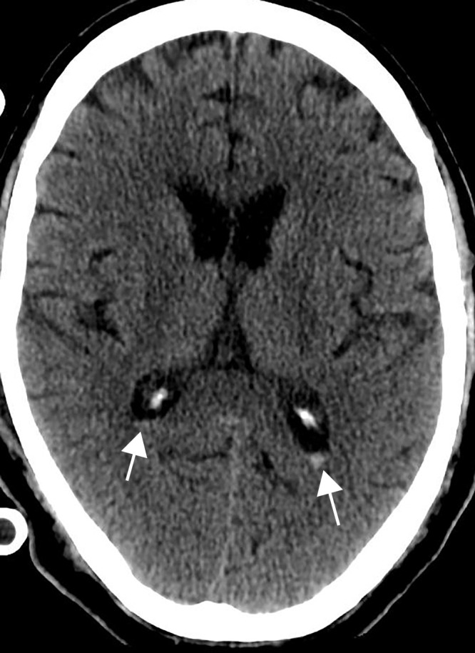 Intraventricular hemorrhage in a 65-year-old man receiving anticoagulation therapy in the intensive care unit as treatment for severe COVID-19 pneumonia. Axial nonenhanced CT image of the head shows a small amount of layering hyperattenuating fluid in the bilateral atria of the lateral ventricles, compatible with either spontaneous or traumatic acute intraventricular hemorrhage.