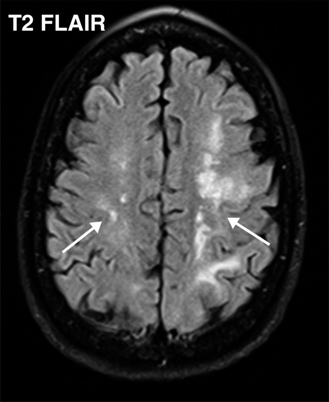 Watershed infarcts and cardioembolic infarcts in a 55-year-old woman with COVID-19 who presented with left gaze deviation. (a) Initial axial T2-weighted (T2) FLAIR brain MR image shows hyperintense signal abnormality (arrows), predominantly within the high frontal and parietal subcortical white matter bilaterally. (b) Repeat axial T2-weighted (T2) FLAIR MR image obtained 3 days later shows interval development of a linearly oriented pattern of signal abnormality (arrows) within the centrum semiovale bilaterally, greater on the left than on the right. (c, d) Axial diffusion-weighted (DWI) (c) and ADC (d) brain MR images show restricted diffusion in the corresponding areas of abnormality (arrows), indicative of watershed infarcts. (e, f) Axial diffusion-weighted (DWI) (e) and ADC (f) brain MR images show restricted diffusion involving the bilateral occipital lobes (arrows), indicative of additional foci of acute infarct.