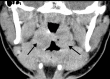 Tonsillitis in a 15-year-old boy who presented to the emergency department with fever, sore throat, malaise, and right neck swelling and was diagnosed with elevated d-dimer levels and inflammatory marker levels. The test results were positive for COVID-19. (a–c) Axial (a) and coronal (b, c) contrast-enhanced neck CT images show enlarged palatine tonsils (black arrows in a and arrows in b). A subtle ill-defined asymmetric area of hypoattenuation is depicted within the enlarged left palatine tonsil, consistent with phlegmon or early abscess (white arrow in a). Associated cervical lymphadenopathy (arrows in c) is depicted. (d) Sagittal power Doppler US image of the right superior neck shows a near-complete occlusive thrombus (arrows) in the right jugular vein (RT IJV).
