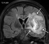 Viral encephalitis in a 57-year-old man with a history of hypoxemic respiratory failure who required intubation in the setting of COVID-19 pneumonia. The hospital stay was complicated by hypercoagulability in the setting of COVID-19. (a, b) Axial (a) and coronal (b) T2-weighted (T2) FLAIR MR images show an infiltrative pattern of heterogeneous signal abnormality (arrows) throughout the left cerebral hemisphere involving the frontal, temporal, and occipital lobes, as well as the basal ganglia and thalamus. (c) Axial susceptibility-weighted image (SWI) shows multiple nodular and curvilinear foci of abnormal magnetic susceptibility (arrows), consistent with foci of parenchymal and subarachnoid hemorrhage. (d) Axial postcontrast T1-weighted MR image shows an amorphous curvilinear pattern of avid contrast enhancement (arrows).