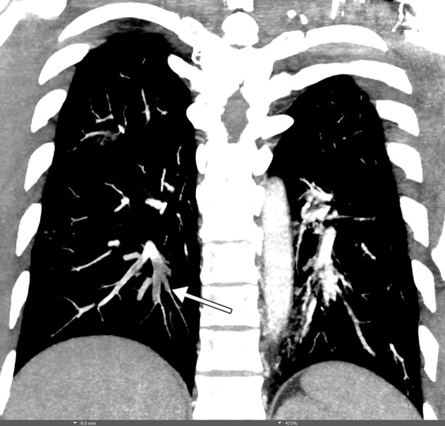 Rhabdomyolysis in a 34-year-old man who presented with minor trauma and was diagnosed with COVID-19 in the emergency department. Laboratory analysis results demonstrated an extremely high creatine kinase level of 35 145 U/L (normal range, 39–308 U/L). (a–c) Coronal (a) and axial (b, c) contrast-enhanced CT images of the pelvis show an enlarged right gluteal region (arrows) without associated fracture. (d–f) Axial (d) and coronal (e) contrast-enhanced chest CT images and a CT image with an artificial intelligence deep learning algorithm for the detection of pulmonary embolism (f) show bilateral multifocal multilobar peribronchovascular patchy airspace and ground-glass opacities (arrows in d), which are a typical finding for COVID-19. Multiple segmental and subsegmental right lower lobe pulmonary emboli (arrows in e and f) were also detected.