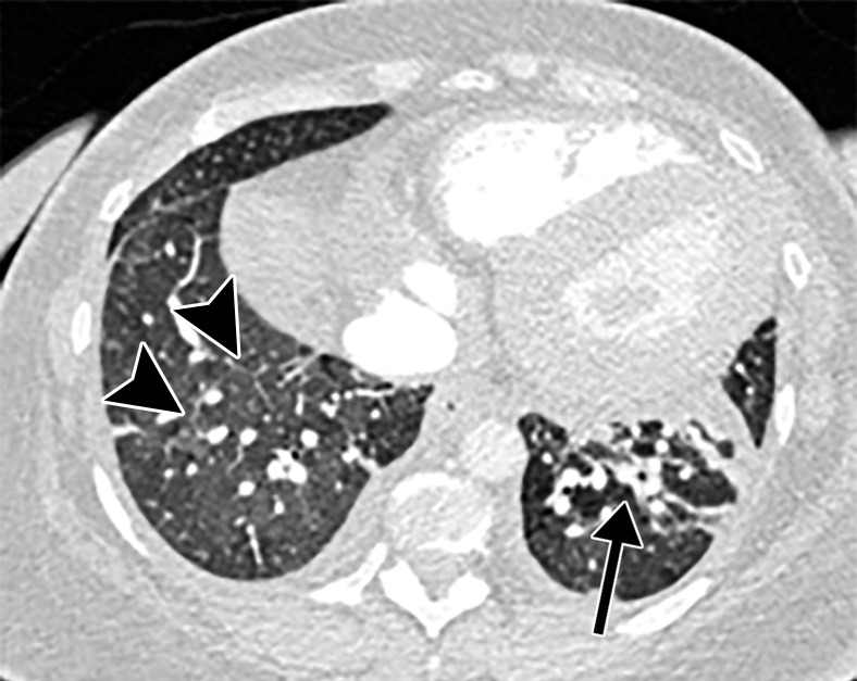 Pulmonary edema in a 50-year-old woman with a history of end-stage renal disease who underwent hemodialysis and who was admitted to the hospital for hypoxia and pneumonia in the setting of COVID-19. (a) Upright posteroranterior chest radiograph obtained at hospital admission shows a right lower lobe consolidation (circle). (b–d) Chest radiograph (b) and axial contrast material–enhanced chest CT images (c, d) obtained after 1 month for persistent hypoxemia show pulmonary edema (with pulmonary venous congestion [black arrows in b] depicted on the chest radiograph), increasing small bilateral pleural effusions (arrows in c), cardiomegaly (arrowheads in b and c), prominent interlobular septal (arrowheads in d) and peribronchovascular (arrow in d) thickening, and diffuse ground-glass opacities. The findings are indicative of pulmonary edema superimposed on the typical appearance of COVID-19 pneumonia. Note that the right lower lobe pneumonia depicted in a is almost completely resolved in b (white arrow in b).