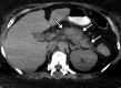 Pancreatitis and enteritis in a 56-year-old woman with COVID-19. Axial (a) and coronal (b) CT images of the abdomen and pelvis obtained with oral (no intravenous) contrast material shows a heterogeneous edematous pancreas with associated inflammatory changes and small amount of peripancreatic fluid (solid arrows), indicative of pancreatitis. Note the nondistended loops of small bowel that show mild wall thickening (dashed arrows in b) and mesenteric inflammation (* in b) that, although they are nonspecific in the setting of pancreatitis, may be indicative of enteritis.