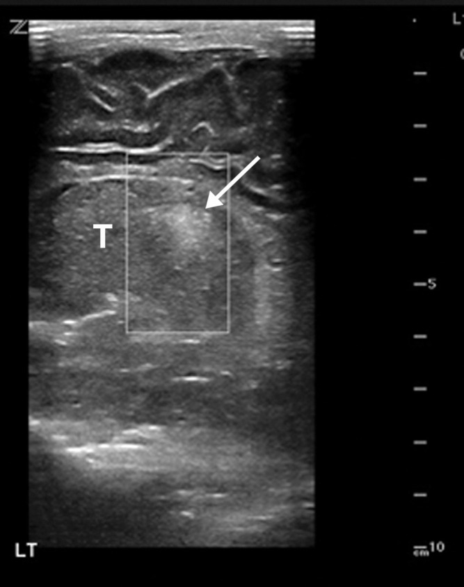 Hypoxic ischemic encephalopathy in a 2-day-old full-term newborn boy who was born by cesarean delivery in a 32-year-old woman with COVID-19. Coagulopathy was diagnosed at birth, with an elevated international normalized ratio of 2.0. The infant died on day 2 following birth. Sagittal gray-scale US images of the neonatal brain obtained at the level of the right (a) and left (b) thalami (T) show increased echogenicity within the thalami (arrows), compatible with hypoxic ischemic encephalopathy. The adjacent midline structures are intact, and no germinal matrix or intraventricular hemorrhage was visualized. The lateral ventricles were normal in size. No parenchymal mass, hematoma, or extra-axial fluid collections were depicted.