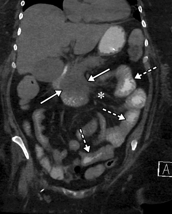 Pancreatitis and enteritis in a 56-year-old woman with COVID-19. Axial (a) and coronal (b) CT images of the abdomen and pelvis obtained with oral (no intravenous) contrast material shows a heterogeneous edematous pancreas with associated inflammatory changes and small amount of peripancreatic fluid (solid arrows), indicative of pancreatitis. Note the nondistended loops of small bowel that show mild wall thickening (dashed arrows in b) and mesenteric inflammation (* in b) that, although they are nonspecific in the setting of pancreatitis, may be indicative of enteritis.