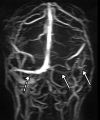 Hemorrhagic venous infarct related to venous thrombosis in a 29-year-old woman who had two seizures after having 1 week of cough and fever and who received positive test results for COVID-19 in the emergency department. (a) Axial nonenhanced head CT image shows a left temporoparietal hemorrhagic venous infarct (arrows), with adjacent edema, mass effect, and minimal rightward midline shift. (b) Axial CT venogram shows absence of contrast material in the left sigmoid sinus (arrows), indicative of venous sinus thrombosis. (c) Three-dimensional maximum intensity projection image from MR venography shows thrombosis of the left transverse and sigmoid sinuses (solid arrows). Note that the right transverse sinus appears patent (dashed arrow).