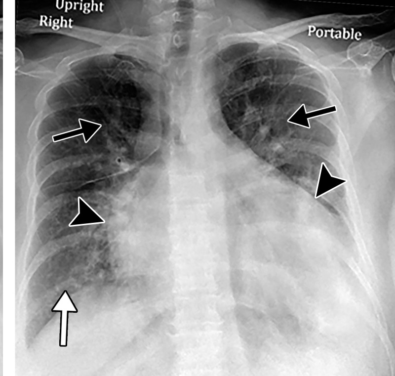 Pulmonary edema in a 50-year-old woman with a history of end-stage renal disease who underwent hemodialysis and who was admitted to the hospital for hypoxia and pneumonia in the setting of COVID-19. (a) Upright posteroranterior chest radiograph obtained at hospital admission shows a right lower lobe consolidation (circle). (b–d) Chest radiograph (b) and axial contrast material–enhanced chest CT images (c, d) obtained after 1 month for persistent hypoxemia show pulmonary edema (with pulmonary venous congestion [black arrows in b] depicted on the chest radiograph), increasing small bilateral pleural effusions (arrows in c), cardiomegaly (arrowheads in b and c), prominent interlobular septal (arrowheads in d) and peribronchovascular (arrow in d) thickening, and diffuse ground-glass opacities. The findings are indicative of pulmonary edema superimposed on the typical appearance of COVID-19 pneumonia. Note that the right lower lobe pneumonia depicted in a is almost completely resolved in b (white arrow in b).