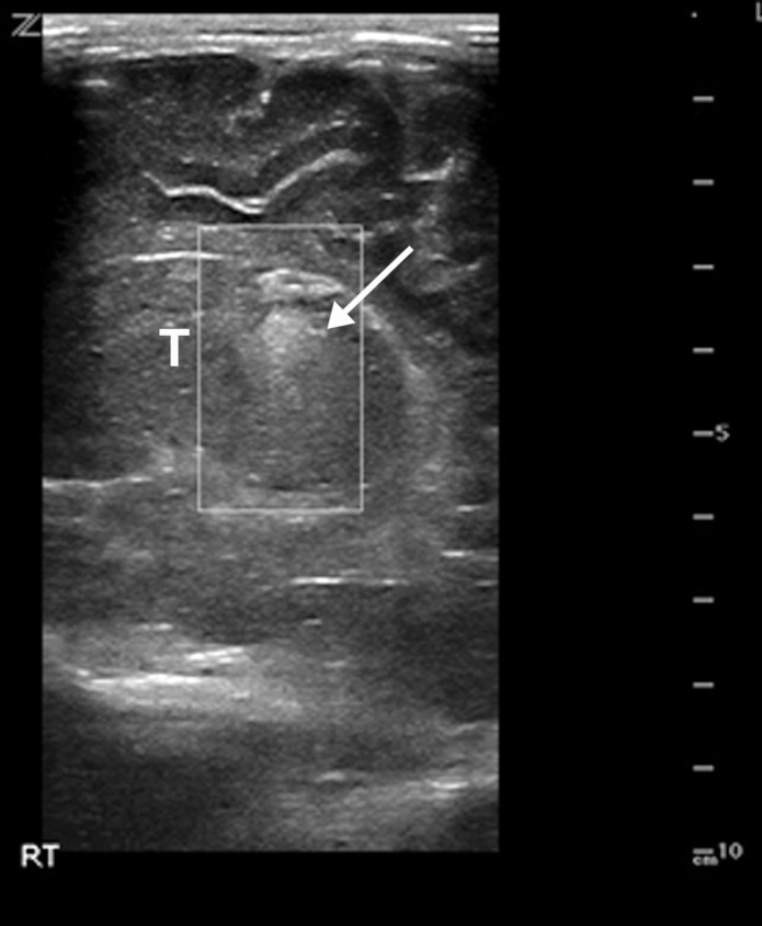 Hypoxic ischemic encephalopathy in a 2-day-old full-term newborn boy who was born by cesarean delivery in a 32-year-old woman with COVID-19. Coagulopathy was diagnosed at birth, with an elevated international normalized ratio of 2.0. The infant died on day 2 following birth. Sagittal gray-scale US images of the neonatal brain obtained at the level of the right (a) and left (b) thalami (T) show increased echogenicity within the thalami (arrows), compatible with hypoxic ischemic encephalopathy. The adjacent midline structures are intact, and no germinal matrix or intraventricular hemorrhage was visualized. The lateral ventricles were normal in size. No parenchymal mass, hematoma, or extra-axial fluid collections were depicted.