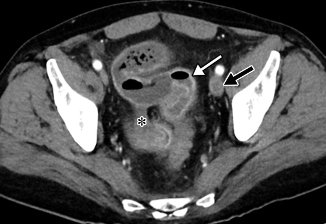 Superior mesenteric artery thrombosis complicated by bowel ischemia and perforation in a 54-year-old man who presented to the emergency department with abdominal pain and was diagnosed with COVID-19. (a–c) Coronal (a) and axial (b, c) contrast-enhanced CT images of the abdomen and pelvis show mucosal hyperenhancement involving the small bowel (F in a, white arrow in c), with associated mild wall thickening. There is a long segment of bowel wall hypoenhancement in the distal ileum, with a large focal wall defect (solid white arrows in a). Note the extension of intraluminal bowel contents, fluid, and air through the defect into the peritoneum (dashed arrow in a). The findings are indicative of bowel ischemia with distal ileal bowel wall perforation. There are multiple fluid-filled dilated loops of small bowel proximal to this region, suggestive of an ileus. There are associated thrombi within the proximal superior mesenteric artery (black arrow in a, arrow in b) and in the distal ileal branches (not shown). Mesenteric congestion and trace ascites are noted (* in a and c). However, no organized fluid collection is depicted. Note the enlarged nonenhancing left external iliac vein, compatible with deep vein thrombosis (black arrow in c). (d) Gray-scale (left) and power Doppler (right) US images of the left upper extremity, obtained owing to arm swelling, show a near-occlusive thrombus extending from the forearm to the upper humeral segment of the cephalic vein (Ceph V) (arrows in d).