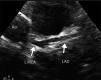 Coronary artery dilatation and decreased ventricular ejection fraction in a 9-year-old boy with a recent history of COVID-19 who presented with new onset of hypotension, kidney disease, and elevated troponin and d-dimer levels (same patient as in Movies 2 and 3). Parasternal short-axis echocardiograms show lack of tapering in the left anterior descending (LAD) coronary artery (arrows in a) and the right coronary artery (RCA) (arrows in b). Left ventricular ejection fraction was decreased (not shown). Ao =aorta, L MCA = left main coronary artery. (Case courtesy of Misra Nilanjana, MD, Northwell Health, New Hyde Park, NY.)