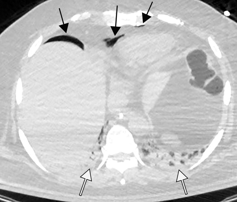 Pneumopericardium with air dissecting into the peritoneum, mimicking bowel perforation, in a 64-year-old man who underwent intubation for COVID-19 pneumonia. (a) Axial nonenhanced chest CT image shows pneumopericardium (black arrows) and bibasilar airspace consolidations (white arrows), compatible with COVID-19 pneumonia. (b) Axial nonenhanced CT image of the abdomen and pelvis shows pneumopericardium and free air under the diaphragm, anterior to the liver (black arrows), without findings of bowel wall ischemia to suggest a perforation (not shown). Note the bibasilar consolidations (white arrows).