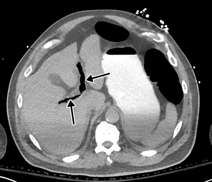 Bowel ischemia and perforation as a complication of COVID-19 in a 65-year-old man with a history of asthma, hypertension, and hyperlipidemia. (a–c) Axial (a, c) and coronal (b, d) intravenous contrast material–enhanced CT images of the abdomen and pelvis show significant pneumatosis of the cecum and right ascending colon (dashed arrows in a and d), with associated perforation of the ascending colon (AC and dashed arrows in b) and a large complex fluid collection with an enhancing rim, indicative of an abscess (solid arrows in b). The abscess is filled with extravasated fecal material. Note the mesenteric venous gas (solid arrows in a), associated with pneumatosis. Note also the small amount of ascites and mesenteric congestion (* in a and d). Portal venous gas is present (solid arrows in c and d). Peripheral airspace disease (black arrow in d) in the right lower lobe is also depicted.