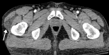 Rhabdomyolysis in a 34-year-old man who presented with minor trauma and was diagnosed with COVID-19 in the emergency department. Laboratory analysis results demonstrated an extremely high creatine kinase level of 35 145 U/L (normal range, 39–308 U/L). (a–c) Coronal (a) and axial (b, c) contrast-enhanced CT images of the pelvis show an enlarged right gluteal region (arrows) without associated fracture. (d–f) Axial (d) and coronal (e) contrast-enhanced chest CT images and a CT image with an artificial intelligence deep learning algorithm for the detection of pulmonary embolism (f) show bilateral multifocal multilobar peribronchovascular patchy airspace and ground-glass opacities (arrows in d), which are a typical finding for COVID-19. Multiple segmental and subsegmental right lower lobe pulmonary emboli (arrows in e and f) were also detected.