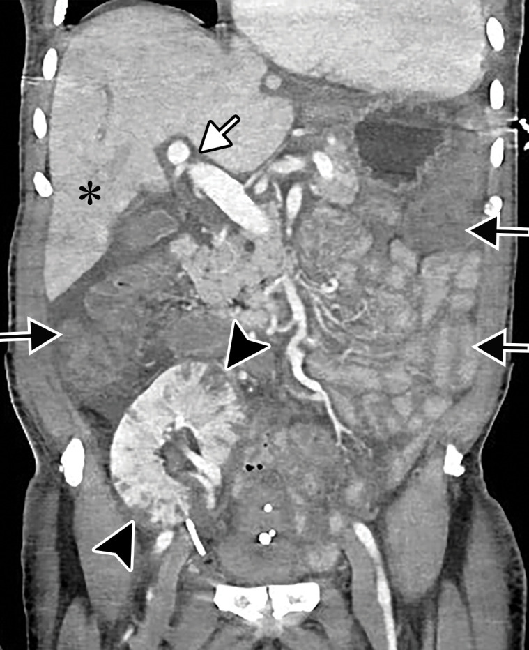 Ischemic enterocolitis, periportal edema, mesenteric congestion, ascites, and multifocal bilateral native and renal transplant infarcts in a severely ill 75-year-old man with COVID-19 pneumonia, elevated liver function test results, and oliguria. (a, b) Coronal (a) and axial (b) contrast-enhanced images of the abdomen and pelvis show marked pericholecystic and periportal edema (white arrows) and thickened small and large bowel (black arrows). Note that the colon is fluid filled. Multifocal wedge-shaped areas of hypoattenuation are depicted in the renal cortex of the transplant kidney allograft and native kidneys (arrowheads), compatible with multifocal native renal and renal transplant infarcts. Note the marked heterogeneity of the liver parenchyma that could be attributable to hepatitis (* in a). The main mesenteric vasculature was patent. Mesenteric congestion and ascites were also present, implying the manifestation of mesenteric ischemia, likely as a result of microthrombosis. (c) Endoscopic image of the left colon shows denudation of the colonic epithelium, compatible with ischemic colitis. (Case courtesy of Christine [Cooky] Menias, MD, Mayo Clinic, Phoenix, Ariz.)