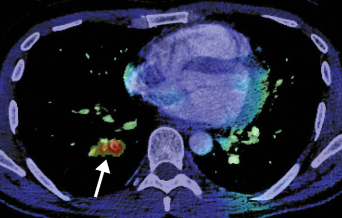 Rhabdomyolysis in a 34-year-old man who presented with minor trauma and was diagnosed with COVID-19 in the emergency department. Laboratory analysis results demonstrated an extremely high creatine kinase level of 35 145 U/L (normal range, 39–308 U/L). (a–c) Coronal (a) and axial (b, c) contrast-enhanced CT images of the pelvis show an enlarged right gluteal region (arrows) without associated fracture. (d–f) Axial (d) and coronal (e) contrast-enhanced chest CT images and a CT image with an artificial intelligence deep learning algorithm for the detection of pulmonary embolism (f) show bilateral multifocal multilobar peribronchovascular patchy airspace and ground-glass opacities (arrows in d), which are a typical finding for COVID-19. Multiple segmental and subsegmental right lower lobe pulmonary emboli (arrows in e and f) were also detected.