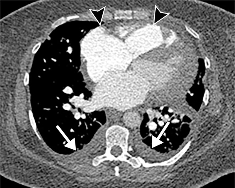 Pulmonary edema in a 50-year-old woman with a history of end-stage renal disease who underwent hemodialysis and who was admitted to the hospital for hypoxia and pneumonia in the setting of COVID-19. (a) Upright posteroranterior chest radiograph obtained at hospital admission shows a right lower lobe consolidation (circle). (b–d) Chest radiograph (b) and axial contrast material–enhanced chest CT images (c, d) obtained after 1 month for persistent hypoxemia show pulmonary edema (with pulmonary venous congestion [black arrows in b] depicted on the chest radiograph), increasing small bilateral pleural effusions (arrows in c), cardiomegaly (arrowheads in b and c), prominent interlobular septal (arrowheads in d) and peribronchovascular (arrow in d) thickening, and diffuse ground-glass opacities. The findings are indicative of pulmonary edema superimposed on the typical appearance of COVID-19 pneumonia. Note that the right lower lobe pneumonia depicted in a is almost completely resolved in b (white arrow in b).