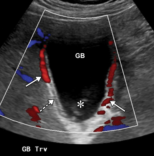 Acute cholecystitis in a critically ill 64-year-old man with COVID-19 and sepsis. Gray-scale (a) and color Doppler (b) US images show a dilated gallbladder (GB) with sludge (* in b). Significant wall edema (dashed arrow) and hyperemia (solid arrows in b) are also present. The US Murphy sign was not assessed owing to the patient’s altered mental status. The findings are indicative of bile stasis and acute cholecystitis. Sterile green thick dark bile was visualized during cholecystostomy placement.