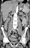 Gastritis and colitis in two patients who each presented with epigastric and abdominal pain and received positive test results for COVID-19 in the emergency department. Coronal contrast-enhanced CT images of the abdomen and pelvis show thickening of the gastric wall and associated mucosal hyperenhancement (arrows in a) and thickening of the ascending and descending colon with mucosal enhancement (arrows in b), findings that are indicative of gastritis (a) and colitis (b), respectively. Note the hepatic steatosis in a.