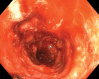 Ischemic enterocolitis, periportal edema, mesenteric congestion, ascites, and multifocal bilateral native and renal transplant infarcts in a severely ill 75-year-old man with COVID-19 pneumonia, elevated liver function test results, and oliguria. (a, b) Coronal (a) and axial (b) contrast-enhanced images of the abdomen and pelvis show marked pericholecystic and periportal edema (white arrows) and thickened small and large bowel (black arrows). Note that the colon is fluid filled. Multifocal wedge-shaped areas of hypoattenuation are depicted in the renal cortex of the transplant kidney allograft and native kidneys (arrowheads), compatible with multifocal native renal and renal transplant infarcts. Note the marked heterogeneity of the liver parenchyma that could be attributable to hepatitis (* in a). The main mesenteric vasculature was patent. Mesenteric congestion and ascites were also present, implying the manifestation of mesenteric ischemia, likely as a result of microthrombosis. (c) Endoscopic image of the left colon shows denudation of the colonic epithelium, compatible with ischemic colitis. (Case courtesy of Christine [Cooky] Menias, MD, Mayo Clinic, Phoenix, Ariz.)