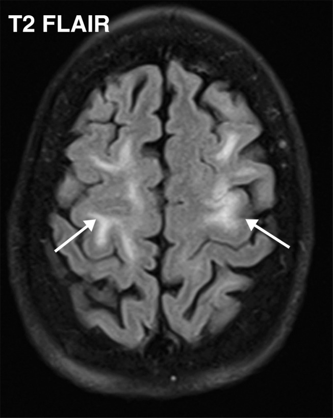 Watershed infarcts and cardioembolic infarcts in a 55-year-old woman with COVID-19 who presented with left gaze deviation. (a) Initial axial T2-weighted (T2) FLAIR brain MR image shows hyperintense signal abnormality (arrows), predominantly within the high frontal and parietal subcortical white matter bilaterally. (b) Repeat axial T2-weighted (T2) FLAIR MR image obtained 3 days later shows interval development of a linearly oriented pattern of signal abnormality (arrows) within the centrum semiovale bilaterally, greater on the left than on the right. (c, d) Axial diffusion-weighted (DWI) (c) and ADC (d) brain MR images show restricted diffusion in the corresponding areas of abnormality (arrows), indicative of watershed infarcts. (e, f) Axial diffusion-weighted (DWI) (e) and ADC (f) brain MR images show restricted diffusion involving the bilateral occipital lobes (arrows), indicative of additional foci of acute infarct.