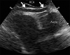 Coronary artery dilatation and decreased ventricular ejection fraction in a 9-year-old boy with a recent history of COVID-19 who presented with new onset of hypotension, kidney disease, and elevated troponin and d-dimer levels (same patient as in Movies 2 and 3). Parasternal short-axis echocardiograms show lack of tapering in the left anterior descending (LAD) coronary artery (arrows in a) and the right coronary artery (RCA) (arrows in b). Left ventricular ejection fraction was decreased (not shown). Ao =aorta, L MCA = left main coronary artery. (Case courtesy of Misra Nilanjana, MD, Northwell Health, New Hyde Park, NY.)