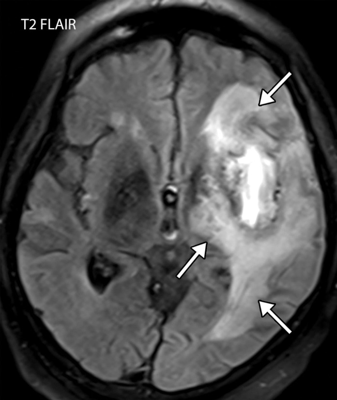 Viral encephalitis in a 57-year-old man with a history of hypoxemic respiratory failure who required intubation in the setting of COVID-19 pneumonia. The hospital stay was complicated by hypercoagulability in the setting of COVID-19. (a, b) Axial (a) and coronal (b) T2-weighted (T2) FLAIR MR images show an infiltrative pattern of heterogeneous signal abnormality (arrows) throughout the left cerebral hemisphere involving the frontal, temporal, and occipital lobes, as well as the basal ganglia and thalamus. (c) Axial susceptibility-weighted image (SWI) shows multiple nodular and curvilinear foci of abnormal magnetic susceptibility (arrows), consistent with foci of parenchymal and subarachnoid hemorrhage. (d) Axial postcontrast T1-weighted MR image shows an amorphous curvilinear pattern of avid contrast enhancement (arrows).