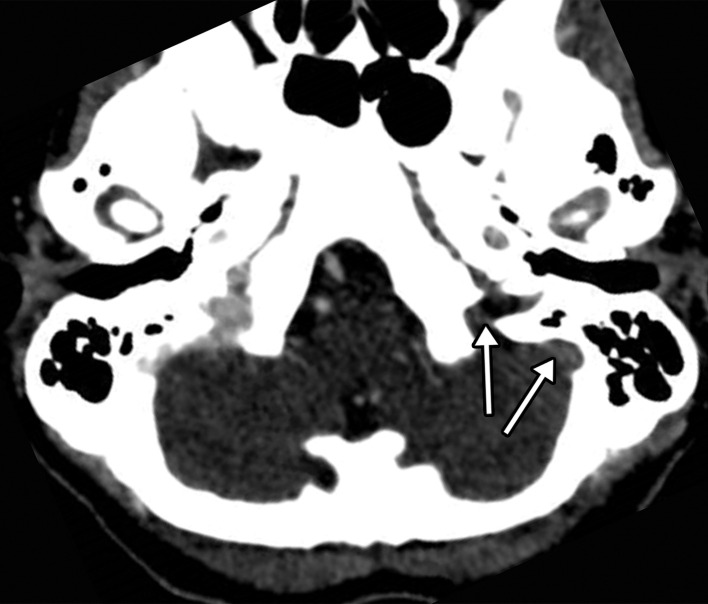 Hemorrhagic venous infarct related to venous thrombosis in a 29-year-old woman who had two seizures after having 1 week of cough and fever and who received positive test results for COVID-19 in the emergency department. (a) Axial nonenhanced head CT image shows a left temporoparietal hemorrhagic venous infarct (arrows), with adjacent edema, mass effect, and minimal rightward midline shift. (b) Axial CT venogram shows absence of contrast material in the left sigmoid sinus (arrows), indicative of venous sinus thrombosis. (c) Three-dimensional maximum intensity projection image from MR venography shows thrombosis of the left transverse and sigmoid sinuses (solid arrows). Note that the right transverse sinus appears patent (dashed arrow).