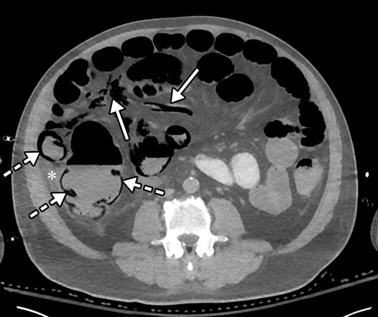 Bowel ischemia and perforation as a complication of COVID-19 in a 65-year-old man with a history of asthma, hypertension, and hyperlipidemia. (a–c) Axial (a, c) and coronal (b, d) intravenous contrast material–enhanced CT images of the abdomen and pelvis show significant pneumatosis of the cecum and right ascending colon (dashed arrows in a and d), with associated perforation of the ascending colon (AC and dashed arrows in b) and a large complex fluid collection with an enhancing rim, indicative of an abscess (solid arrows in b). The abscess is filled with extravasated fecal material. Note the mesenteric venous gas (solid arrows in a), associated with pneumatosis. Note also the small amount of ascites and mesenteric congestion (* in a and d). Portal venous gas is present (solid arrows in c and d). Peripheral airspace disease (black arrow in d) in the right lower lobe is also depicted.