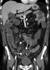 Superior mesenteric artery thrombosis complicated by bowel ischemia and perforation in a 54-year-old man who presented to the emergency department with abdominal pain and was diagnosed with COVID-19. (a–c) Coronal (a) and axial (b, c) contrast-enhanced CT images of the abdomen and pelvis show mucosal hyperenhancement involving the small bowel (F in a, white arrow in c), with associated mild wall thickening. There is a long segment of bowel wall hypoenhancement in the distal ileum, with a large focal wall defect (solid white arrows in a). Note the extension of intraluminal bowel contents, fluid, and air through the defect into the peritoneum (dashed arrow in a). The findings are indicative of bowel ischemia with distal ileal bowel wall perforation. There are multiple fluid-filled dilated loops of small bowel proximal to this region, suggestive of an ileus. There are associated thrombi within the proximal superior mesenteric artery (black arrow in a, arrow in b) and in the distal ileal branches (not shown). Mesenteric congestion and trace ascites are noted (* in a and c). However, no organized fluid collection is depicted. Note the enlarged nonenhancing left external iliac vein, compatible with deep vein thrombosis (black arrow in c). (d) Gray-scale (left) and power Doppler (right) US images of the left upper extremity, obtained owing to arm swelling, show a near-occlusive thrombus extending from the forearm to the upper humeral segment of the cephalic vein (Ceph V) (arrows in d).