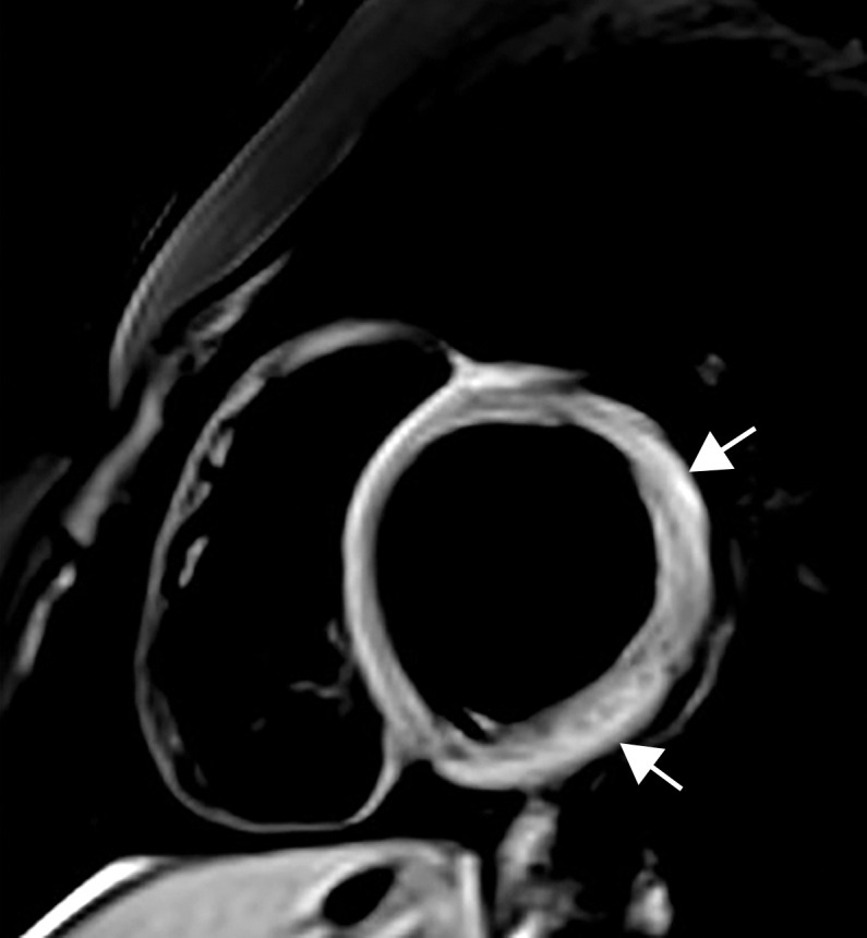 Myocarditis in a 17-year-old adolescent boy who presented to the pediatric emergency room with chest pain and was diagnosed with elevated troponin levels, diffuse ST-segment elevation at electrocardiography, ventricular ectopy, and COVID-19. (a) Cardiac short-axis T2-weighted fat-saturated black-blood MR image shows diffuse increased signal intensity in the subepicardial layer of the septal, lateral, and inferolateral walls in the basal segment (arrows) and subepicardial layer of the lateral and inferolateral walls of the midventricular segments (not shown), consistent with edema. (b) Precontrast T1-weighted short-axis fat-saturated MR image shows normal myocardial thickness and signal intensity (arrows). (c, d) Postcontrast short-axis T1-weighted cardiac MR images obtained at the same level as b show early (c) and delayed (d) subepicardial enhancement of the basal anterior, anterolateral, inferolateral, and inferior segments in a nonischemic pattern (arrows), findings consistent with myocarditis given the clinical context. The enhancement area corresponds to the T2 signal abnormality depicted in a.