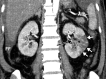 Renal infarcts in a 57-year-old man with COVID-19, diagnosed after presenting to the emergency department with abdominal pain. Coronal contrast-enhanced CT image of the abdomen and pelvis shows multiple linear hypoattenuating areas, extending from the left renal sinus to the surface of the cortex (white arrows). Note the occlusive thrombus (black arrow) in the segmental left renal artery. The findings are indicative of an infarct of the left kidney. Small wedge-shaped regions of hypoattenuation were also present in the right kidney, indicative of an infarct (not shown). Note the small amount of perihepatic free fluid (FF).