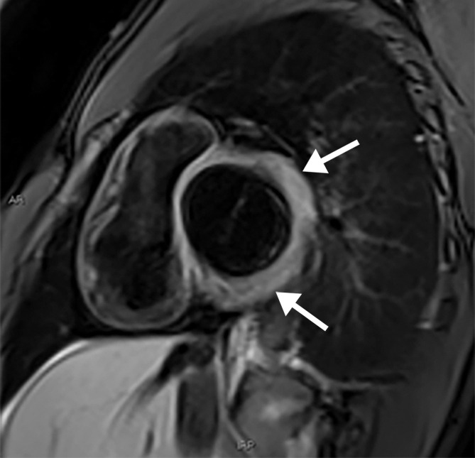 Myocarditis in a 17-year-old adolescent boy who presented to the pediatric emergency room with chest pain and was diagnosed with elevated troponin levels, diffuse ST-segment elevation at electrocardiography, ventricular ectopy, and COVID-19. (a) Cardiac short-axis T2-weighted fat-saturated black-blood MR image shows diffuse increased signal intensity in the subepicardial layer of the septal, lateral, and inferolateral walls in the basal segment (arrows) and subepicardial layer of the lateral and inferolateral walls of the midventricular segments (not shown), consistent with edema. (b) Precontrast T1-weighted short-axis fat-saturated MR image shows normal myocardial thickness and signal intensity (arrows). (c, d) Postcontrast short-axis T1-weighted cardiac MR images obtained at the same level as b show early (c) and delayed (d) subepicardial enhancement of the basal anterior, anterolateral, inferolateral, and inferior segments in a nonischemic pattern (arrows), findings consistent with myocarditis given the clinical context. The enhancement area corresponds to the T2 signal abnormality depicted in a.