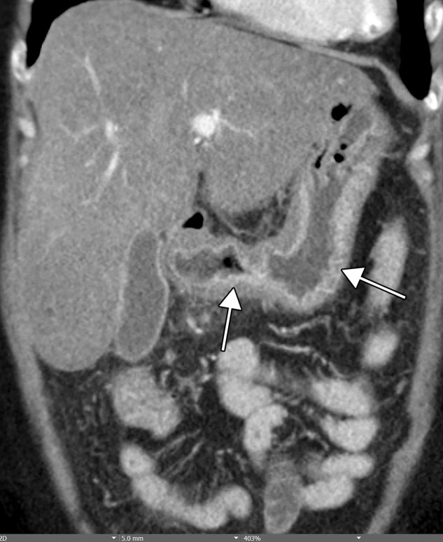 Gastritis and colitis in two patients who each presented with epigastric and abdominal pain and received positive test results for COVID-19 in the emergency department. Coronal contrast-enhanced CT images of the abdomen and pelvis show thickening of the gastric wall and associated mucosal hyperenhancement (arrows in a) and thickening of the ascending and descending colon with mucosal enhancement (arrows in b), findings that are indicative of gastritis (a) and colitis (b), respectively. Note the hepatic steatosis in a.