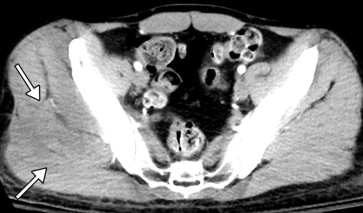 Rhabdomyolysis in a 34-year-old man who presented with minor trauma and was diagnosed with COVID-19 in the emergency department. Laboratory analysis results demonstrated an extremely high creatine kinase level of 35 145 U/L (normal range, 39–308 U/L). (a–c) Coronal (a) and axial (b, c) contrast-enhanced CT images of the pelvis show an enlarged right gluteal region (arrows) without associated fracture. (d–f) Axial (d) and coronal (e) contrast-enhanced chest CT images and a CT image with an artificial intelligence deep learning algorithm for the detection of pulmonary embolism (f) show bilateral multifocal multilobar peribronchovascular patchy airspace and ground-glass opacities (arrows in d), which are a typical finding for COVID-19. Multiple segmental and subsegmental right lower lobe pulmonary emboli (arrows in e and f) were also detected.