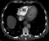 Right ventricular thrombus and COVID-19 pneumonia in a 62-year-old man with hypoxia and markedly elevated d-dimer levels (>50 000 ng/mL). Axial chest CT angiographic image shows a well-circumscribed hypoattenuating filling defect within the lumen of the right ventricle, indicative of a thrombus (solid arrow). Patchy lung opacities (dashed arrows) related to COVID-19 pneumonia are only vaguely depicted, owing to the window settings used.