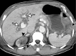 Ischemic enterocolitis, periportal edema, mesenteric congestion, ascites, and multifocal bilateral native and renal transplant infarcts in a severely ill 75-year-old man with COVID-19 pneumonia, elevated liver function test results, and oliguria. (a, b) Coronal (a) and axial (b) contrast-enhanced images of the abdomen and pelvis show marked pericholecystic and periportal edema (white arrows) and thickened small and large bowel (black arrows). Note that the colon is fluid filled. Multifocal wedge-shaped areas of hypoattenuation are depicted in the renal cortex of the transplant kidney allograft and native kidneys (arrowheads), compatible with multifocal native renal and renal transplant infarcts. Note the marked heterogeneity of the liver parenchyma that could be attributable to hepatitis (* in a). The main mesenteric vasculature was patent. Mesenteric congestion and ascites were also present, implying the manifestation of mesenteric ischemia, likely as a result of microthrombosis. (c) Endoscopic image of the left colon shows denudation of the colonic epithelium, compatible with ischemic colitis. (Case courtesy of Christine [Cooky] Menias, MD, Mayo Clinic, Phoenix, Ariz.)