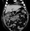 Bowel ischemia and perforation as a complication of COVID-19 in a 65-year-old man with a history of asthma, hypertension, and hyperlipidemia. (a–c) Axial (a, c) and coronal (b, d) intravenous contrast material–enhanced CT images of the abdomen and pelvis show significant pneumatosis of the cecum and right ascending colon (dashed arrows in a and d), with associated perforation of the ascending colon (AC and dashed arrows in b) and a large complex fluid collection with an enhancing rim, indicative of an abscess (solid arrows in b). The abscess is filled with extravasated fecal material. Note the mesenteric venous gas (solid arrows in a), associated with pneumatosis. Note also the small amount of ascites and mesenteric congestion (* in a and d). Portal venous gas is present (solid arrows in c and d). Peripheral airspace disease (black arrow in d) in the right lower lobe is also depicted.