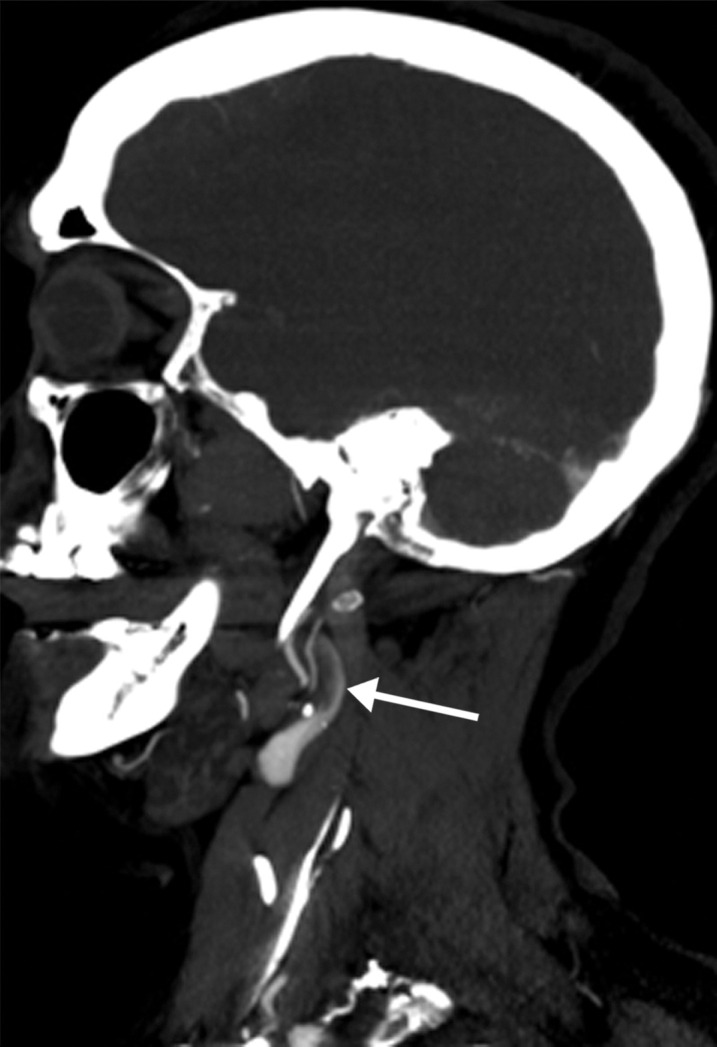 Long segment right internal carotid artery (ICA) occlusion with associated bilateral large middle cerebral artery territory infarcts in a 59-year-old man who underwent intubation due to COVID-19 who presented with sudden onset of confusion. The serum analysis results showed a high d-dimer level of 5.6 mg/mL. (a) Axial nonenhanced head CT image shows large regions of hypoattenuation (arrows) in the bilateral middle cerebral artery territories, reflecting cytotoxic edema secondary to acute bilateral middle cerebral artery territorial infarctions without hemorrhagic transformation. The findings are indicative of cardioembolic phenomena (given various vascular distributions), hypoxic-ischemic injury, or ischemic vasculopathy secondary to COVID-19. (b–d) Sagittal maximum intensity projection (b) and axial head and neck CT angiographic images (c, d) show a long segment filling defect from the proximal cervical segment of the right ICA (arrow in b) to the intracranial ICA, with involvement of the right petrous (not shown) and cavernous ICA segments (arrow in c), indicative of right ICA thrombosis and occlusion. The right carotid terminus (white arrow in d) and right middle cerebral artery are completely occluded, and the M1 segment of the left middle cerebral artery is nearly completely occluded, with only a small sleeve of intravenous contrast material opacifying the artery (black arrow in d). Note that the loss of gray matter–white matter differentiation is more pronounced on the right (arrowheads in d).