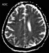 Multiple brain infarcts in various vascular territories and intraparenchymal hemorrhage after extubation in a 58-year-old woman with a history of diabetes mellitus who was hospitalized with COVID-19. The patient’s hospital stay was complicated by multiorgan failure, line sepsis, and new neurologic deficits. (a) Axial T2-weighted (T2) FLAIR brain MR image shows a focal heterogeneous hyperintensity (arrow) within the right occipital lobe, representing an evolving intraparenchymal hematoma, with surrounding edema and mass effect. (b, c) Axial diffusion-weighted (DWI) and ADC MR images show restricted diffusion in the right frontal lobe, compatible with a small focus of acute infarct (arrow). Additional foci of restricted diffusion were depicted in the left frontal lobe (not shown), consistent with small infarcts in different vascular distributions.