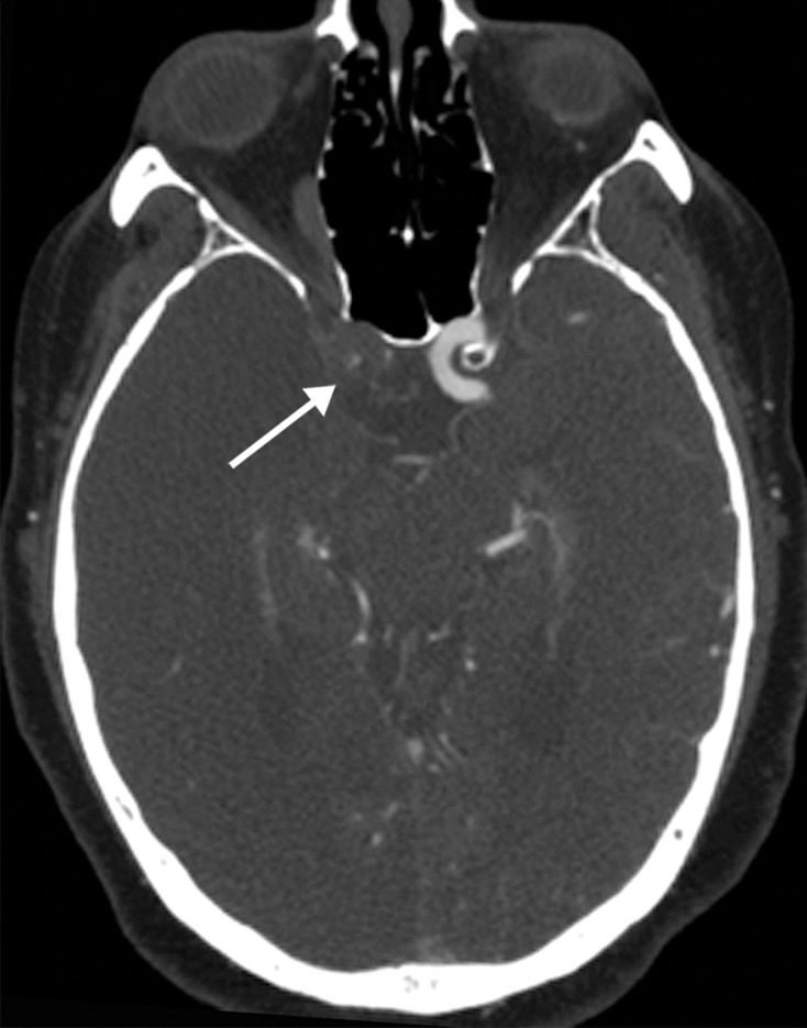 Long segment right internal carotid artery (ICA) occlusion with associated bilateral large middle cerebral artery territory infarcts in a 59-year-old man who underwent intubation due to COVID-19 who presented with sudden onset of confusion. The serum analysis results showed a high d-dimer level of 5.6 mg/mL. (a) Axial nonenhanced head CT image shows large regions of hypoattenuation (arrows) in the bilateral middle cerebral artery territories, reflecting cytotoxic edema secondary to acute bilateral middle cerebral artery territorial infarctions without hemorrhagic transformation. The findings are indicative of cardioembolic phenomena (given various vascular distributions), hypoxic-ischemic injury, or ischemic vasculopathy secondary to COVID-19. (b–d) Sagittal maximum intensity projection (b) and axial head and neck CT angiographic images (c, d) show a long segment filling defect from the proximal cervical segment of the right ICA (arrow in b) to the intracranial ICA, with involvement of the right petrous (not shown) and cavernous ICA segments (arrow in c), indicative of right ICA thrombosis and occlusion. The right carotid terminus (white arrow in d) and right middle cerebral artery are completely occluded, and the M1 segment of the left middle cerebral artery is nearly completely occluded, with only a small sleeve of intravenous contrast material opacifying the artery (black arrow in d). Note that the loss of gray matter–white matter differentiation is more pronounced on the right (arrowheads in d).