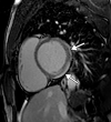 Myocarditis in a 17-year-old adolescent boy who presented to the pediatric emergency room with chest pain and was diagnosed with elevated troponin levels, diffuse ST-segment elevation at electrocardiography, ventricular ectopy, and COVID-19. (a) Cardiac short-axis T2-weighted fat-saturated black-blood MR image shows diffuse increased signal intensity in the subepicardial layer of the septal, lateral, and inferolateral walls in the basal segment (arrows) and subepicardial layer of the lateral and inferolateral walls of the midventricular segments (not shown), consistent with edema. (b) Precontrast T1-weighted short-axis fat-saturated MR image shows normal myocardial thickness and signal intensity (arrows). (c, d) Postcontrast short-axis T1-weighted cardiac MR images obtained at the same level as b show early (c) and delayed (d) subepicardial enhancement of the basal anterior, anterolateral, inferolateral, and inferior segments in a nonischemic pattern (arrows), findings consistent with myocarditis given the clinical context. The enhancement area corresponds to the T2 signal abnormality depicted in a.