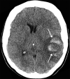 Hemorrhagic venous infarct related to venous thrombosis in a 29-year-old woman who had two seizures after having 1 week of cough and fever and who received positive test results for COVID-19 in the emergency department. (a) Axial nonenhanced head CT image shows a left temporoparietal hemorrhagic venous infarct (arrows), with adjacent edema, mass effect, and minimal rightward midline shift. (b) Axial CT venogram shows absence of contrast material in the left sigmoid sinus (arrows), indicative of venous sinus thrombosis. (c) Three-dimensional maximum intensity projection image from MR venography shows thrombosis of the left transverse and sigmoid sinuses (solid arrows). Note that the right transverse sinus appears patent (dashed arrow).