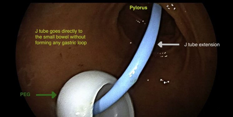PEG J tube placement with optimization of J tube insertion - PMC