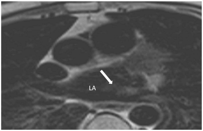 The Coumadin Ridge: An Important Example of a Left Atrial Pseudotumour ...