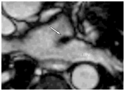 The Coumadin Ridge: An Important Example of a Left Atrial Pseudotumour ...