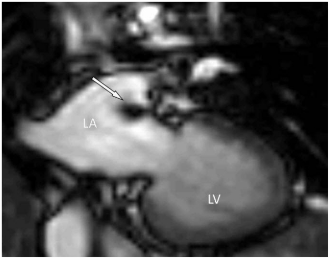 The Coumadin Ridge: An Important Example of a Left Atrial Pseudotumour ...