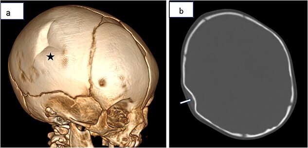 Ping pong fracture - PMC