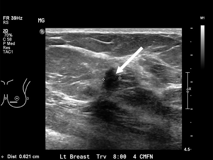 Images in a 71-year-old woman, after lumpectomy in the right breast. The mammogram in 2016 was negative. (a) US image obtained several days later shows a mass with posterior shadowing at eight o’clock position (arrow) in the left breast. (b) The molecular breast imaging result was negative. The subsequent MRI, mammographic, and US results were negative for 2 years. CC = craniocaudal, MLO = mediolateral oblique.